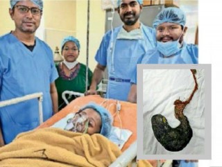 १८ वर्षीया युवतीको पेटमा कपालको गुजुल्टो