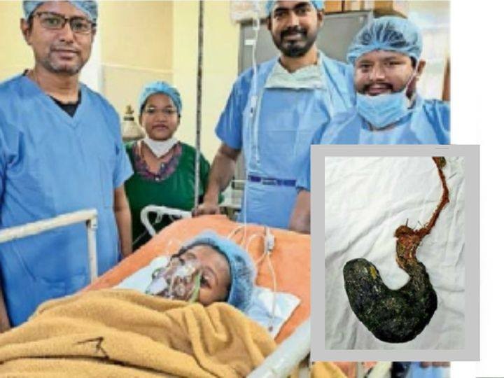 १८ वर्षीया युवतीको पेटमा कपालको गुजुल्टो