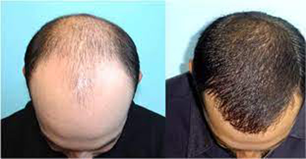 कपाल किन झर्छ ? यस्ता छन् कपाल झर्नाका कारणहरु