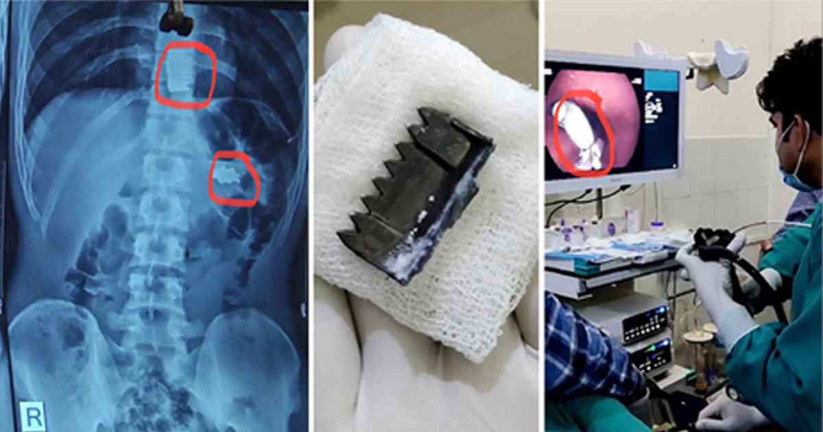 नोबेल अस्पतालमा बिरामीको पेटबाट निकालियो पेटीको ‘बक्कल’ र सिक्री