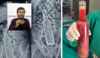 पेटभित्र रक्सीको बोतल भेटिएका युवक अस्पतालबाट भए डिस्चार्ज