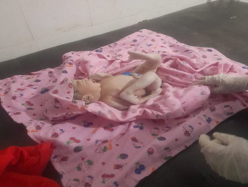 बैतडीमा टाउकोतिर खुट्टा पल्टिएको अचम्मको शिशु जन्मियो