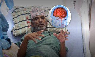केएमसीमा ६७ वर्षीय वृद्धको मस्तिष्कको जटिल ‘एभीएम’ को विना चिरफार सफल उपचारः नेपालकै पहिलो घटना भएको दाबी